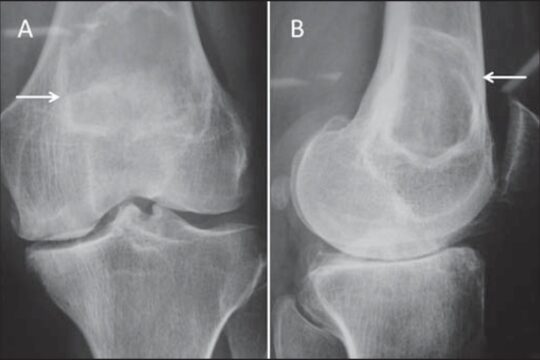 Knee Benign Bone Tumor